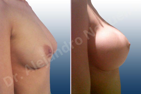 Empty breasts,Lateral breasts,Slightly saggy droopy breasts,Small breasts,Extra large size,Lower hemi periareolar incision,Round shape,Subfascial pocket plane - photo 4