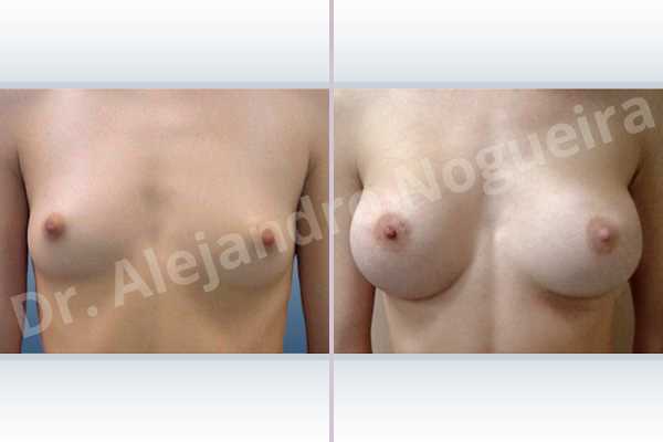 Asymmetric breasts,Lateral breasts,Narrow breasts,Skinny breasts,Small breasts,Sunken chest,Too far apart wide cleavage breasts,Anatomical shape,Lower hemi periareolar incision,Subfascial pocket plane - photo 1