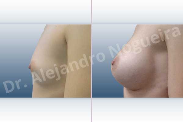 Asymmetric breasts,Lateral breasts,Narrow breasts,Skinny breasts,Small breasts,Sunken chest,Too far apart wide cleavage breasts,Anatomical shape,Lower hemi periareolar incision,Subfascial pocket plane - photo 2
