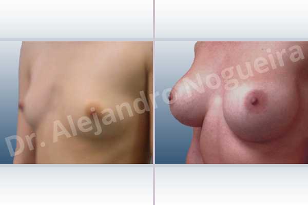 Asymmetric breasts,Lateral breasts,Narrow breasts,Skinny breasts,Small breasts,Sunken chest,Too far apart wide cleavage breasts,Anatomical shape,Lower hemi periareolar incision,Subfascial pocket plane - photo 3