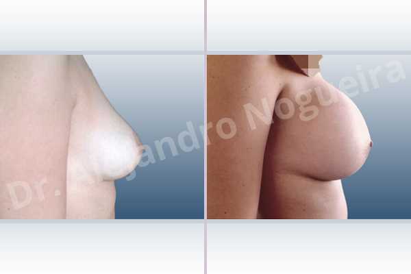 Cross eyed breasts,Empty breasts,Mildly saggy droopy breasts,Slightly large breasts,Extra large size,Lower hemi periareolar incision,Round shape,Subfascial pocket plane - photo 4