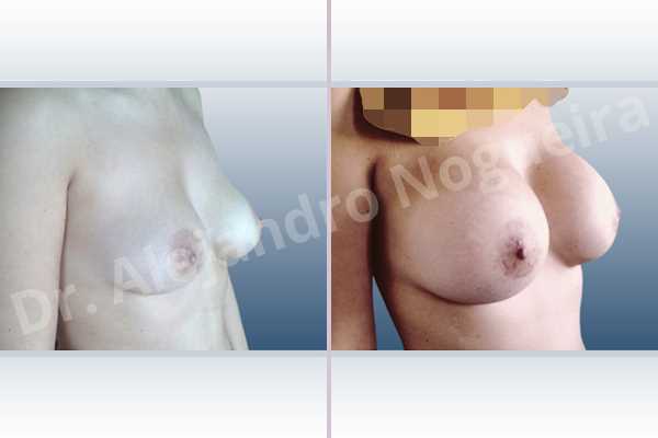 Cross eyed breasts,Empty breasts,Mildly saggy droopy breasts,Slightly large breasts,Extra large size,Lower hemi periareolar incision,Round shape,Subfascial pocket plane - photo 5