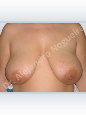 Cross eyed breasts,Extremely saggy droopy breasts,Pendulous breasts,Pigmented scars,Severely saggy droopy breasts,Wide breasts,Anchor incision,Double vertical pedicle