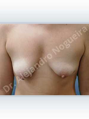 Asymmetric breasts,Empty breasts,Moderately saggy droopy breasts,Pendulous breasts,Severely saggy droopy breasts,Small breasts,Tuberous breasts,Anatomical shape,Lower hemi periareolar incision,Subfascial pocket plane,Tuberous mammoplasty