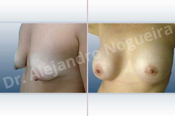Asymmetric breasts,Empty breasts,Moderately saggy droopy breasts,Pendulous breasts,Severely saggy droopy breasts,Small breasts,Tuberous breasts,Anatomical shape,Lower hemi periareolar incision,Subfascial pocket plane,Tuberous mammoplasty - photo 3