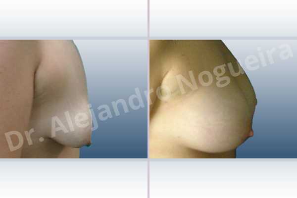Asymmetric breasts,Empty breasts,Moderately saggy droopy breasts,Pendulous breasts,Severely saggy droopy breasts,Small breasts,Tuberous breasts,Anatomical shape,Lower hemi periareolar incision,Subfascial pocket plane,Tuberous mammoplasty - photo 4