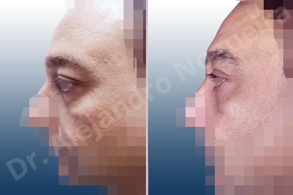 Baggy lower eyelids,Baggy upper eyelids,Deep nasolabial folds,Droopy cheeks,Droopy eyebrows,Droopy face,Droopy forehead,Saggy upper eyelids,Lower eyelid fat bags resection,Short temporal incisions supraperiosteal extended lift of the upper two thirds of the face,Transconjunctival approach incision,Upper eyelid fat bags resection,Upper eyelid skin and muscle resection - photo 2