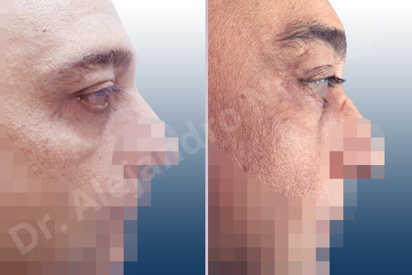 Baggy lower eyelids,Baggy upper eyelids,Deep nasolabial folds,Droopy cheeks,Droopy eyebrows,Droopy face,Droopy forehead,Saggy upper eyelids,Lower eyelid fat bags resection,Short temporal incisions supraperiosteal extended lift of the upper two thirds of the face,Transconjunctival approach incision,Upper eyelid fat bags resection,Upper eyelid skin and muscle resection - photo 4