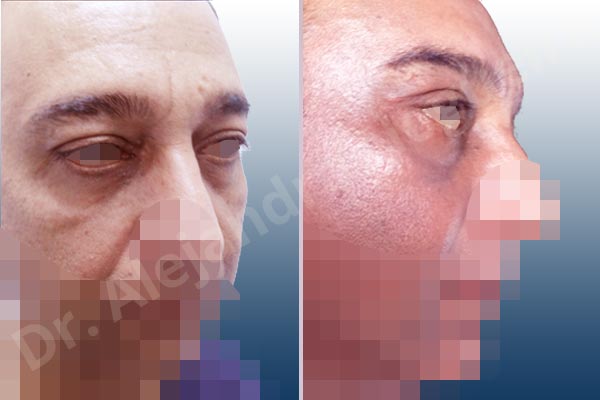 Baggy lower eyelids,Baggy upper eyelids,Deep nasolabial folds,Droopy cheeks,Droopy eyebrows,Droopy face,Droopy forehead,Saggy upper eyelids,Lower eyelid fat bags resection,Short temporal incisions supraperiosteal extended lift of the upper two thirds of the face,Transconjunctival approach incision,Upper eyelid fat bags resection,Upper eyelid skin and muscle resection - photo 5
