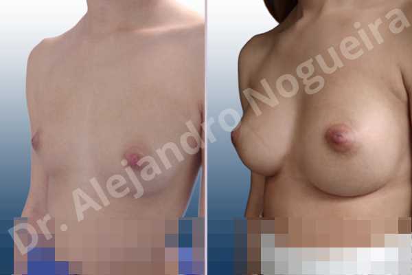 Cleft nipples,Cross eyed breasts,Empty breasts,Inverted nipples,Small breasts,Too far apart wide cleavage breasts,Wide scars,Anatomical shape,Lower hemi periareolar incision,Subfascial pocket plane - photo 3