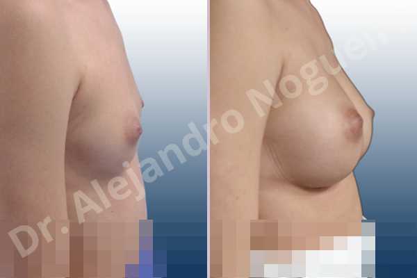 Cleft nipples,Cross eyed breasts,Empty breasts,Inverted nipples,Small breasts,Too far apart wide cleavage breasts,Wide scars,Anatomical shape,Lower hemi periareolar incision,Subfascial pocket plane - photo 4