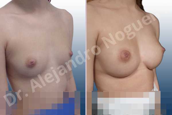 Cleft nipples,Cross eyed breasts,Empty breasts,Inverted nipples,Small breasts,Too far apart wide cleavage breasts,Wide scars,Anatomical shape,Lower hemi periareolar incision,Subfascial pocket plane - photo 5