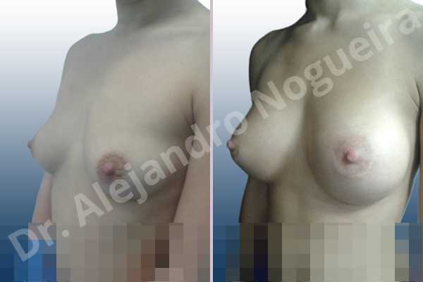 Asymmetric breasts,Cross eyed breasts,Empty breasts,Lateral breasts,Slightly saggy droopy breasts,Small breasts,Sunken chest,Too far apart wide cleavage breasts,Anatomical shape,Lower hemi periareolar incision,Subfascial pocket plane - photo 3