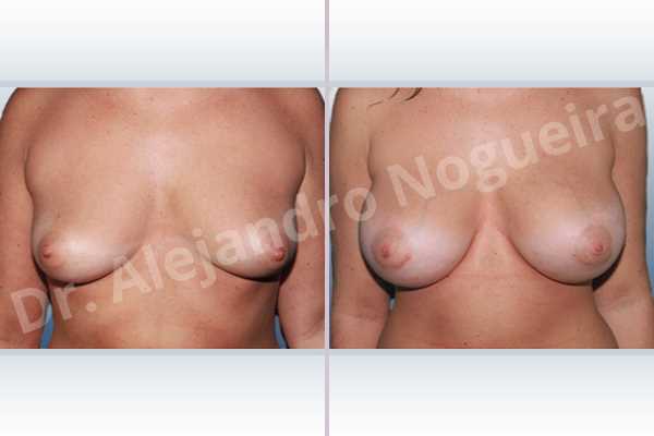 Empty breasts,Lateral breasts,Mildly saggy droopy breasts,Moderately saggy droopy breasts,Slightly large breasts,Tuberous breasts,Wide breasts,Lower hemi periareolar incision,Round shape,Subfascial pocket plane,Tuberous mammoplasty,Extra large size - photo 1