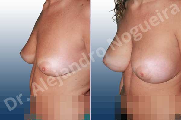 Empty breasts,Lateral breasts,Mildly saggy droopy breasts,Moderately saggy droopy breasts,Slightly large breasts,Tuberous breasts,Wide breasts,Lower hemi periareolar incision,Round shape,Subfascial pocket plane,Tuberous mammoplasty,Extra large size - photo 2