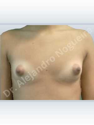 Asymmetric breasts,Lateral breasts,Small breasts,Too far apart wide cleavage breasts,Tuberous breasts,Anatomical shape,Lower hemi periareolar incision,Subfascial pocket plane,Tuberous mammoplasty