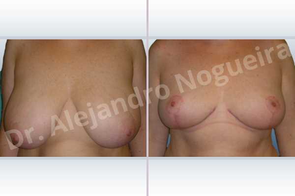 Cross eyed breasts,Extremely saggy droopy breasts,Lateral breasts,Pendulous breasts,Severely large breasts,Severely saggy droopy breasts,Tuberous breasts,Wide breasts,Anchor incision,Double vertical pedicle - photo 1
