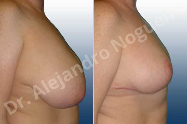 Cross eyed breasts,Extremely saggy droopy breasts,Lateral breasts,Pendulous breasts,Severely large breasts,Severely saggy droopy breasts,Tuberous breasts,Wide breasts,Anchor incision,Double vertical pedicle - photo 4