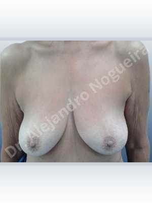 Empty breasts,Pendulous breasts,Severely saggy droopy breasts,Slightly large breasts,Wide breasts,Anatomical shape,Anchor incision,Subfascial pocket plane,Superior pedicle