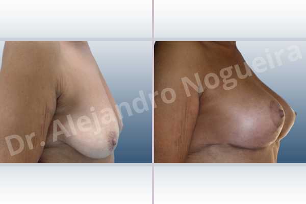 Empty breasts,Pendulous breasts,Severely saggy droopy breasts,Slightly large breasts,Wide breasts,Anatomical shape,Anchor incision,Subfascial pocket plane,Superior pedicle - photo 3