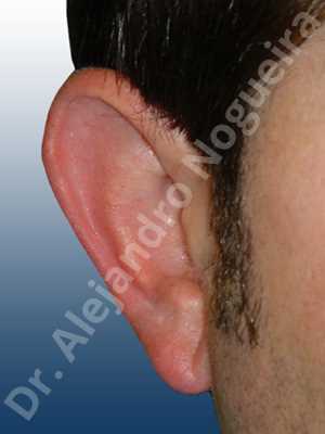 Prominent ears,Mustardé antihelical suturing