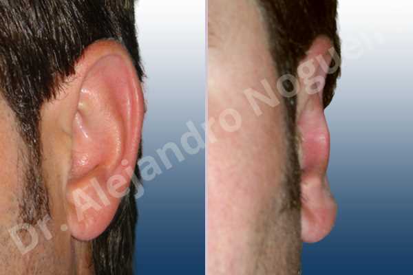 Prominent ears,Mustardé antihelical suturing - photo 2