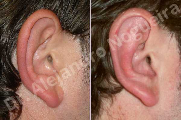 Prominent ears,Mustardé antihelical suturing - photo 3