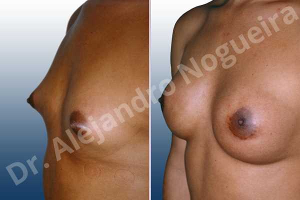 Small breasts,Too far apart wide cleavage breasts,Transgender breasts,Wide breasts,Lower hemi periareolar incision,Round shape,Subfascial pocket plane - photo 1