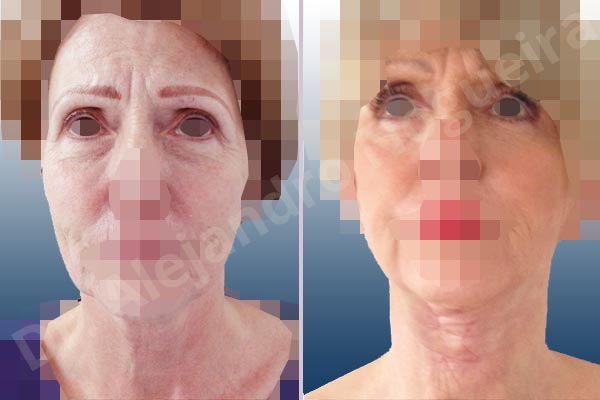 Baggy lower eyelids,Deep nasolabial folds,Droopy cheeks,Droopy face,Saggy jowls,Saggy neck,Saggy upper eyelids,Deep plane SMAS platysma face and neck lift,Lower eyelid fat bags resection,Transconjunctival approach incision,Upper eyelid skin and muscle resection - photo 1