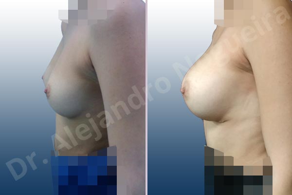 Empty breasts,Narrow breasts,Small breasts,Inframammary incision,Round shape,Subfascial pocket plane - photo 2