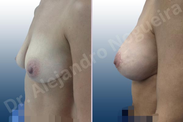 Cross eyed breasts,Empty breasts,Large areolas,Lateral breasts,Moderately saggy droopy breasts,Skinny breasts,Small breasts,Anatomical shape,Lollipop incision,Subfascial pocket plane,Superior pedicle - photo 2