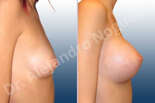 Asymmetric breasts,Empty breasts,Lateral breasts,Narrow breasts,Skinny breasts,Small breasts,Too far apart wide cleavage breasts,Inframammary incision,Round shape,Subfascial pocket plane - photo 4