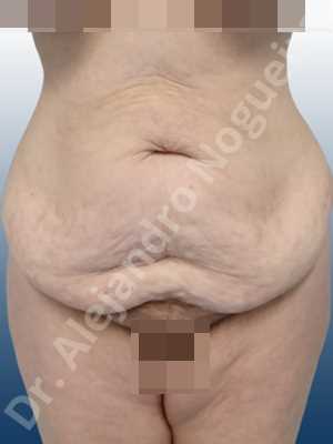 Saggy abdomen,Weak abdomen muscles,Standard abdominoplasty
