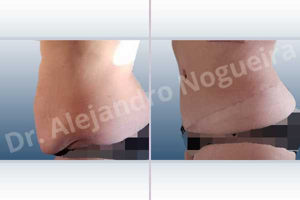Saggy abdomen,Weak abdomen muscles,Standard abdominoplasty - photo 5