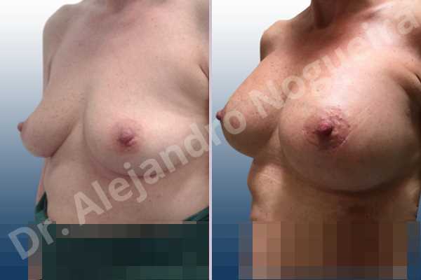 Empty breasts,Lateral breasts,Mildly saggy droopy breasts,Small breasts,Too far apart wide cleavage breasts,Wide breasts,Anatomical shape,Lower hemi periareolar incision,Subfascial pocket plane - photo 3
