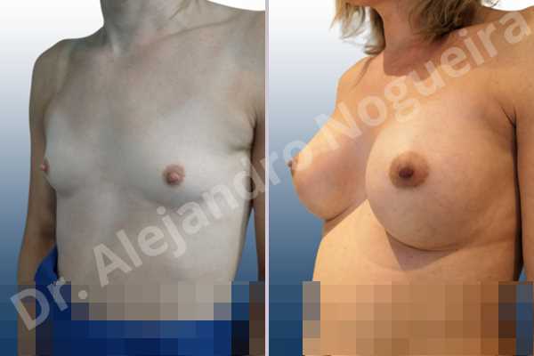 Cross eyed breasts,Empty breasts,Lateral breasts,Narrow breasts,Skinny breasts,Small breasts,Sunken chest,Too far apart wide cleavage breasts,Transgender breasts,Anatomical shape,Inframammary incision,Subfascial pocket plane - photo 3
