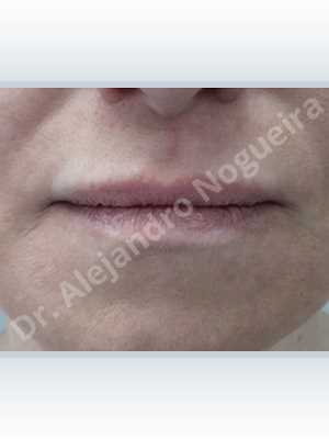 Small lips,Lower lip autologous dermis collagen filler,Upper lip autologous dermis collagen filler