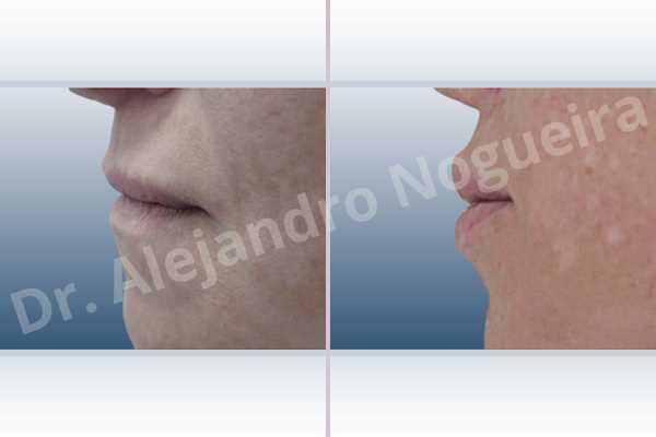 Small lips,Lower lip autologous dermis collagen filler,Upper lip autologous dermis collagen filler - photo 2