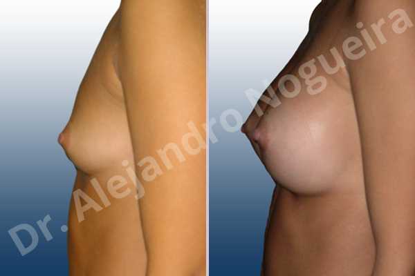 Lateral breasts,Narrow breasts,Skinny breasts,Small breasts,Sunken chest,Too far apart wide cleavage breasts,Anatomical shape,Lower hemi periareolar incision,Subfascial pocket plane - photo 2