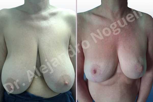 Asymmetric breasts,Breast tissue bottoming out,Extremely saggy droopy breasts,Large areolas,Pendulous breasts,Severely large breasts,Anchor incision,Areola reduction,Double vertical pedicle - photo 1