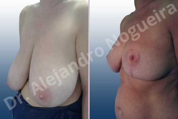 Asymmetric breasts,Breast tissue bottoming out,Extremely saggy droopy breasts,Large areolas,Pendulous breasts,Severely large breasts,Anchor incision,Areola reduction,Double vertical pedicle - photo 3