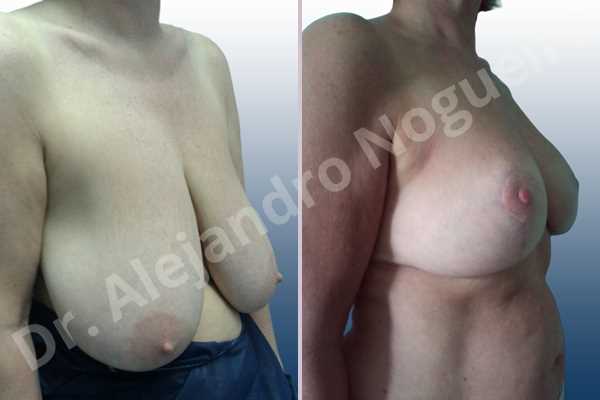 Asymmetric breasts,Breast tissue bottoming out,Extremely saggy droopy breasts,Large areolas,Pendulous breasts,Severely large breasts,Anchor incision,Areola reduction,Double vertical pedicle - photo 5