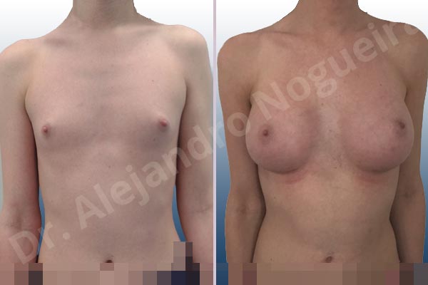 Lateral breasts,Narrow breasts,Skinny breasts,Small breasts,Too far apart wide cleavage breasts,Transgender breasts,Anatomical shape,Inframammary incision,Subfascial pocket plane - photo 1