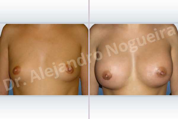 Asymmetric breasts,Empty breasts,Lateral breasts,Small breasts,Too far apart wide cleavage breasts,Wide breasts,Anatomical shape,Extra large size,Lower hemi periareolar incision,Subfascial pocket plane - photo 1