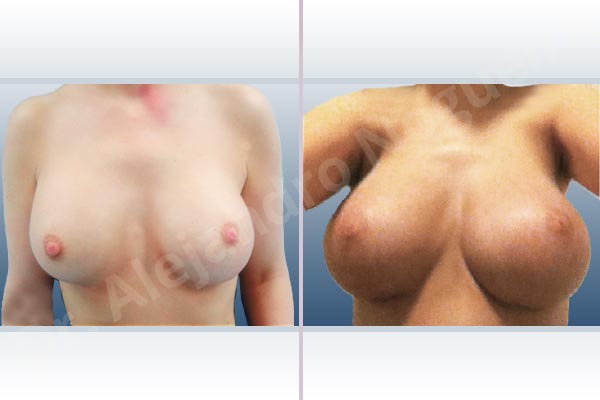 Asymmetric breasts,Breast implants animation muscle flex deformity,Breast implants displacement malposition,Breast implants double bubble deformity,Breast implants excessive movement,Breast implants riding too high,Empty breasts,Lateral breasts,Mildly saggy droopy breasts,Skinny breasts,Slightly saggy droopy breasts,Small breasts,Too far apart wide cleavage breast implants,Too far apart wide cleavage breasts,Too narrow breast implants,Capsulectomy,Custom made size and shape,Extra large size,Inframammary incision,Round shape,Subfascial pocket plane - photo 2