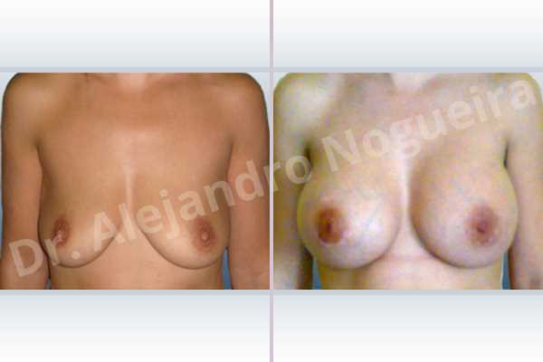Empty breasts,Mildly saggy droopy breasts,Slightly saggy droopy breasts,Small breasts,Anatomical shape,Extra large size,Lower hemi periareolar incision,Subfascial pocket plane - photo 1
