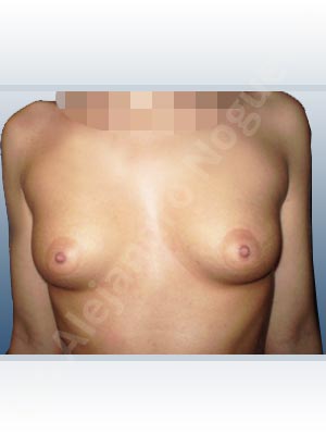 Cross eyed breasts,Empty breasts,Lateral breasts,Narrow breasts,Skinny breasts,Small breasts,Sunken chest,Too far apart wide cleavage breasts,Tuberous breasts,Extra large size,Lower hemi periareolar incision,Round shape,Subfascial pocket plane,Tuberous mammoplasty