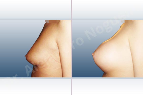 Cross eyed breasts,Empty breasts,Lateral breasts,Narrow breasts,Skinny breasts,Small breasts,Sunken chest,Too far apart wide cleavage breasts,Tuberous breasts,Extra large size,Lower hemi periareolar incision,Round shape,Subfascial pocket plane,Tuberous mammoplasty - photo 2