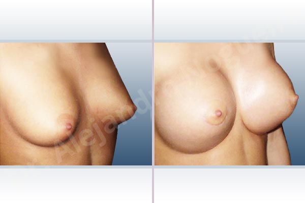 Cross eyed breasts,Empty breasts,Lateral breasts,Narrow breasts,Skinny breasts,Small breasts,Sunken chest,Too far apart wide cleavage breasts,Tuberous breasts,Extra large size,Lower hemi periareolar incision,Round shape,Subfascial pocket plane,Tuberous mammoplasty - photo 5