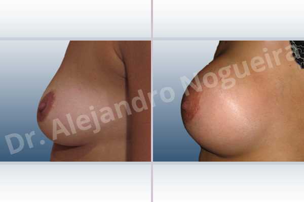 Asymmetric breasts,Empty breasts,Slightly saggy droopy breasts,Small breasts,Lower hemi periareolar incision,Round shape,Subfascial pocket plane - photo 2